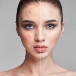 เทคนิคการรักษาสิว สูตรโบราณทำได้ด้วยตัวเอง