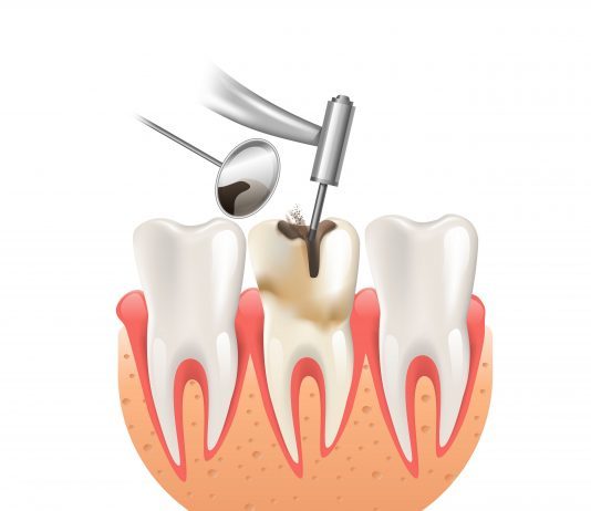 รักษารากฟันคืออะไร ขั้นตอนการรักษา ฉบับเข้าใจง่าย